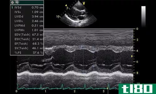 心电图(ecg)和超声心动图(echocardiography)的区别