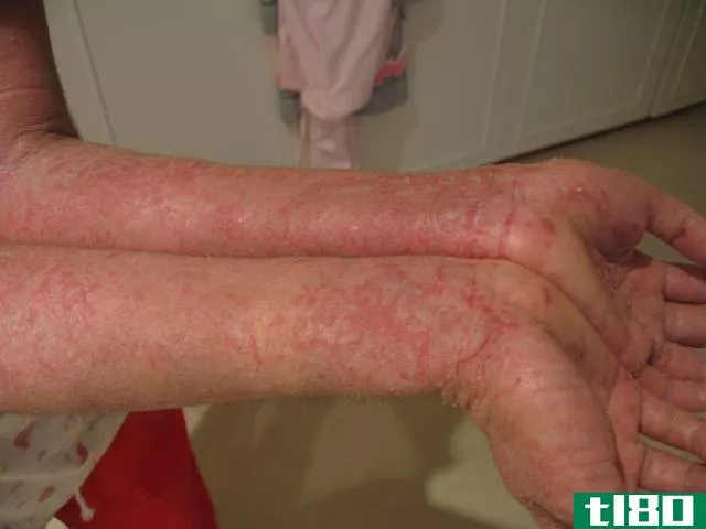 湿疹(eczema)和癣(ringworm)的区别
