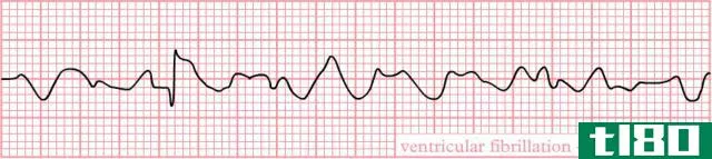 室性心动过速(ventricular tachycardia (vtach))和心室颤动(ventricular fibrillation (vfib))的区别
