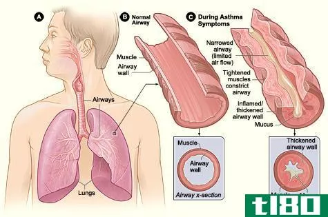 哮喘(asthma)和慢性阻塞性肺病(copd)的区别