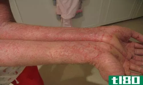 湿疹(eczema)和特应性皮炎(atopic dermatitis)的区别