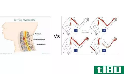 脊髓病的区别(differences between myelopathy)和神经根病(radiculopathy)的区别