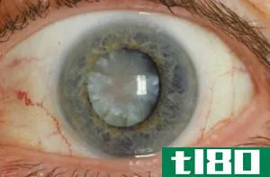 青光眼(glaucoma)和白内障(cataract)的区别
