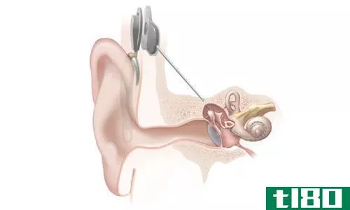巴哈(baha)和人工耳蜗(cochlear implant)的区别