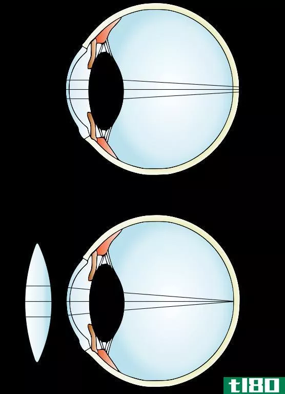 近视(myopia)和远视(hypermetropia)的区别