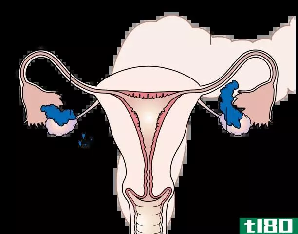 卵巢囊肿(ovarian cyst)和卵巢癌(ovarian cancer)的区别
