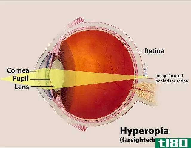 远视(hyperopia)和老花眼(presbyopia)的区别