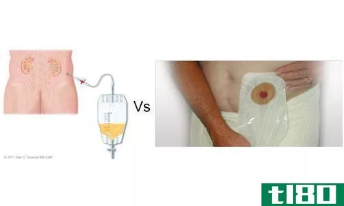 肾造口术的区别(differences between nephrostomy)和尿道造口术(urostomy)的区别