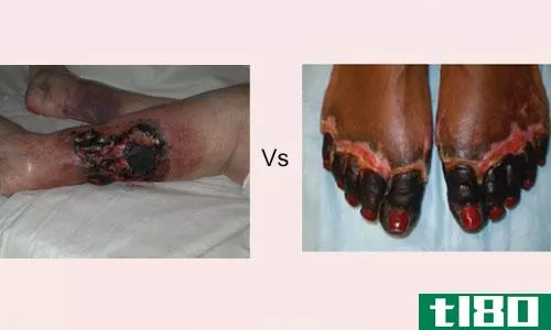 坏死(necrosis)和坏疽(gangrene)的区别