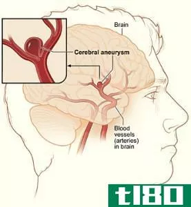 动静脉畸形(avm)和脑动脉瘤(brain aneury**)的区别