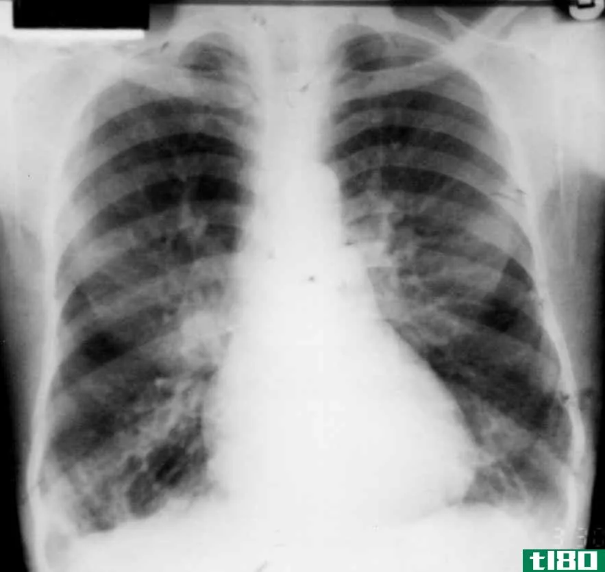 慢性支气管炎(chronic bronchitis)和肺气肿(emphysema)的区别