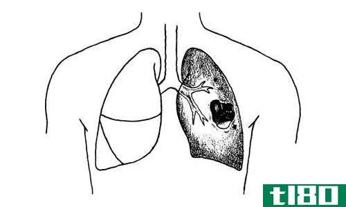 肺炎(pneumonia)和肺脓肿。(lung abscess.)的区别