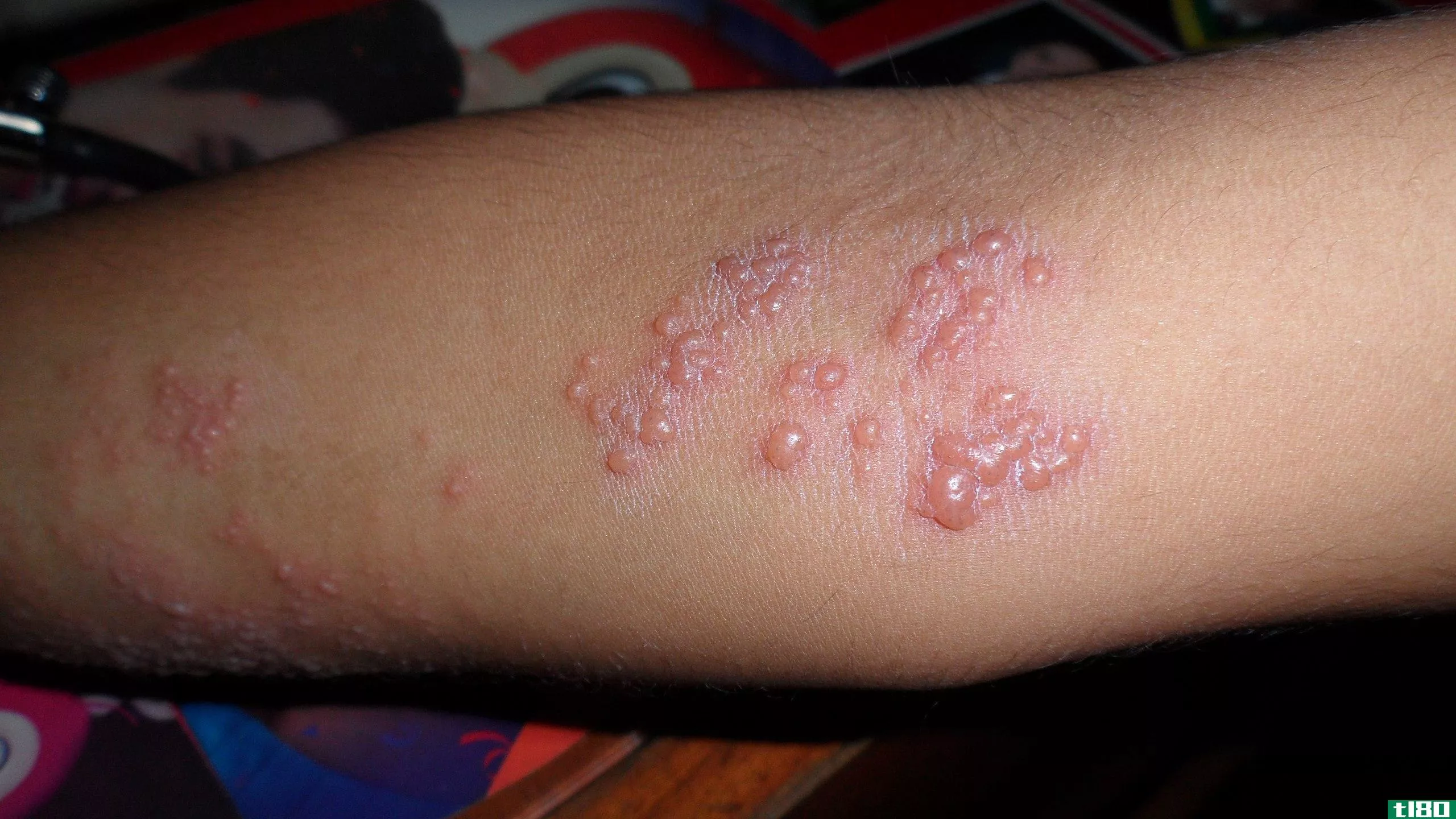水痘(chickenpox)和木瓦(shingles)的区别