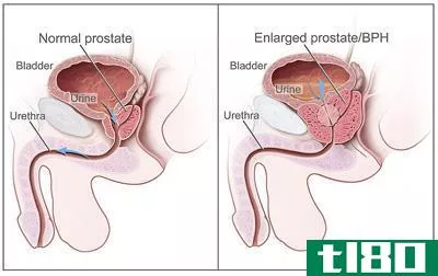 前列腺增生(bph)和****(prostate cancer)的区别