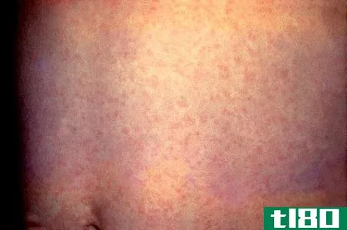 麻疹(measles)和风疹(rubella)的区别