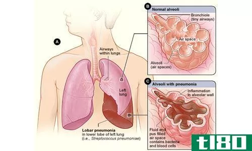 什么是温和的，温和的(what is the  mild, moderate)和重症肺炎(severe pneumonia)的区别