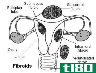 纤维瘤(fibroids)和囊肿(cysts)的区别