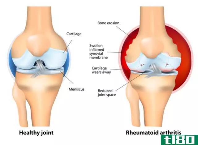 关节炎(arthritis)和滑囊炎(bursitis)的区别