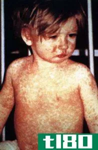麻疹(measles)和风疹(rubella)的区别
