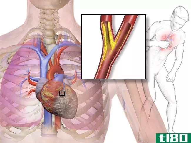 心肌缺血的区别(differences between myocardial ischemia)和心肌梗塞(myocardial infarction)的区别