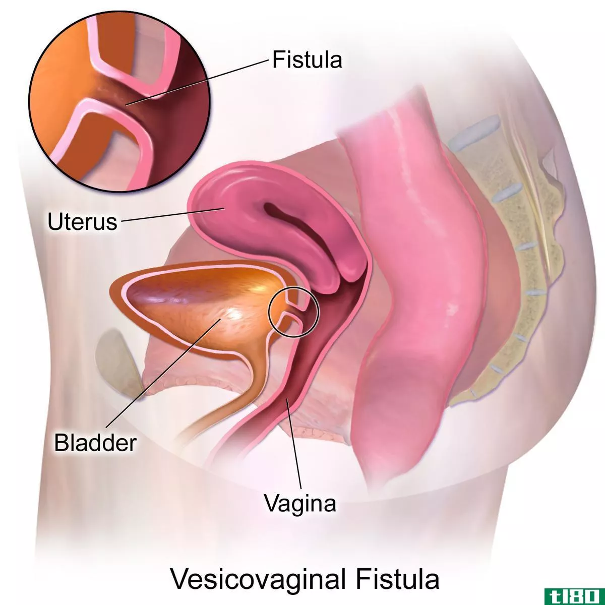瘘管(fistula)和分流器(shunt)的区别