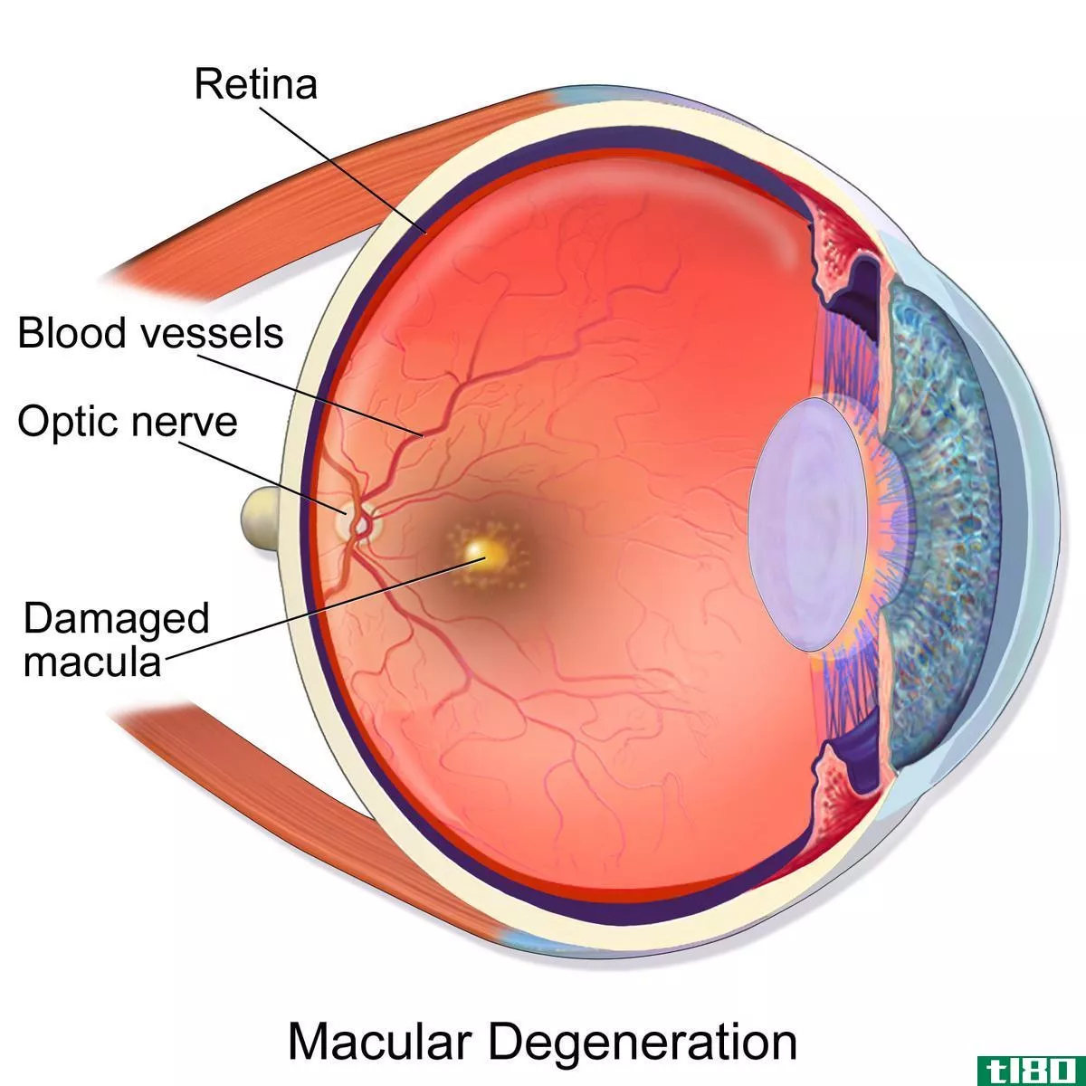 糖尿病性视网膜病变(diabetic retinopathy)和黄斑变性(macular degeneration)的区别