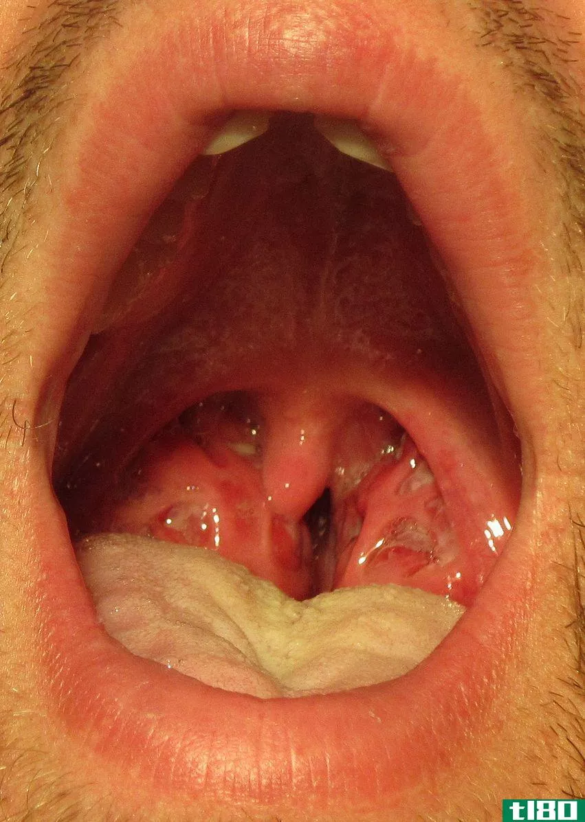 衣原体(chlamydia)和链球菌性咽喉炎(strep throat)的区别
