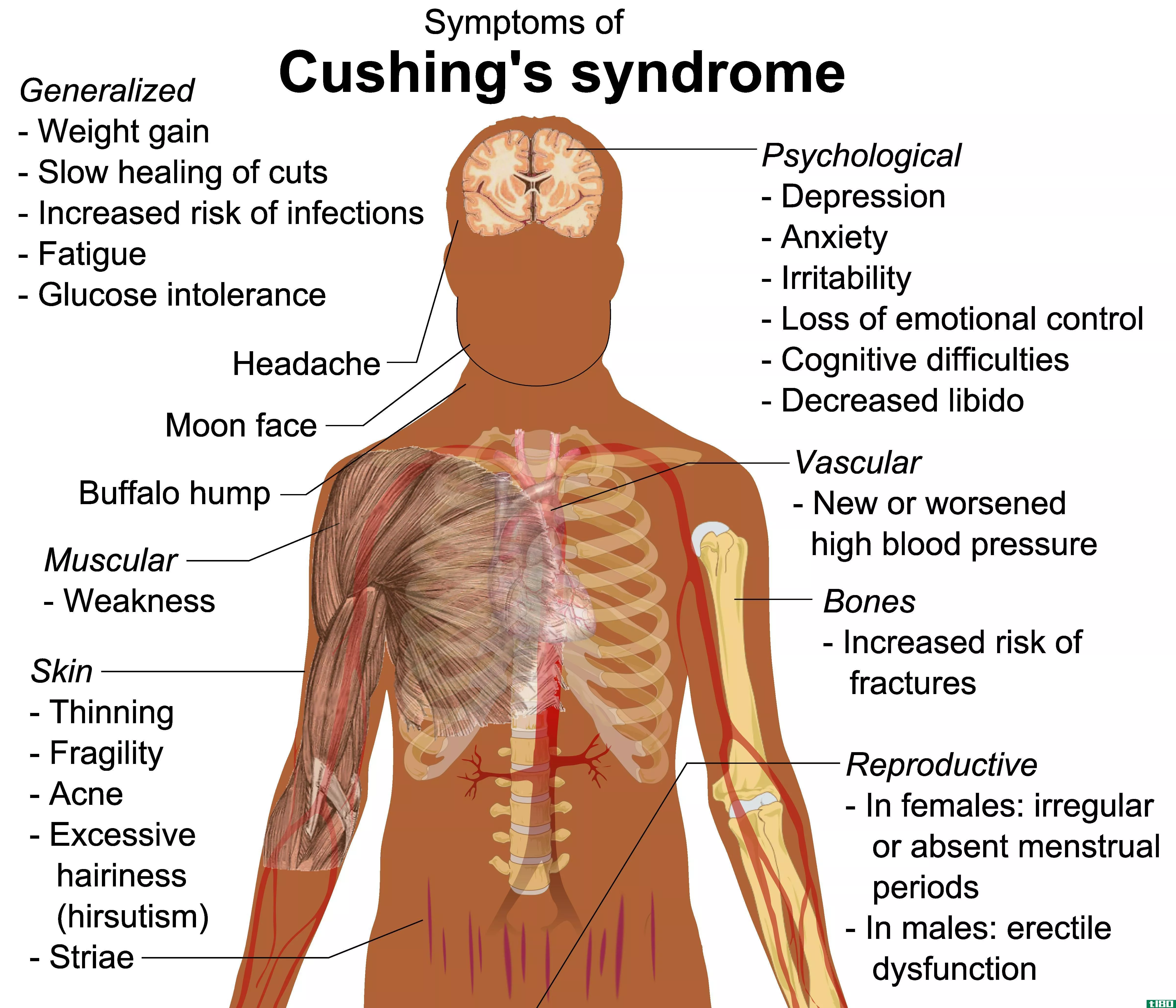 库欣病(cushing’s disease)和库欣综合征(cushing’s syndrome)的区别
