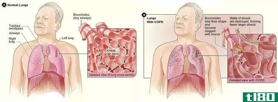 慢性阻塞性肺病(copd)和肺的  纤维化(pulmonary  fibrosis)的区别