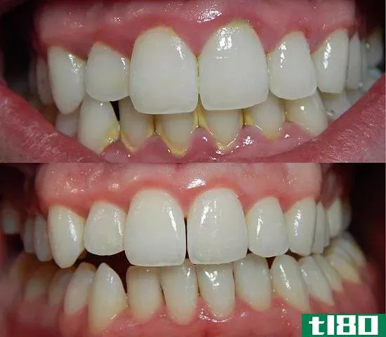 牙龈炎(gingivitis)和牙周炎(periodontitis)的区别