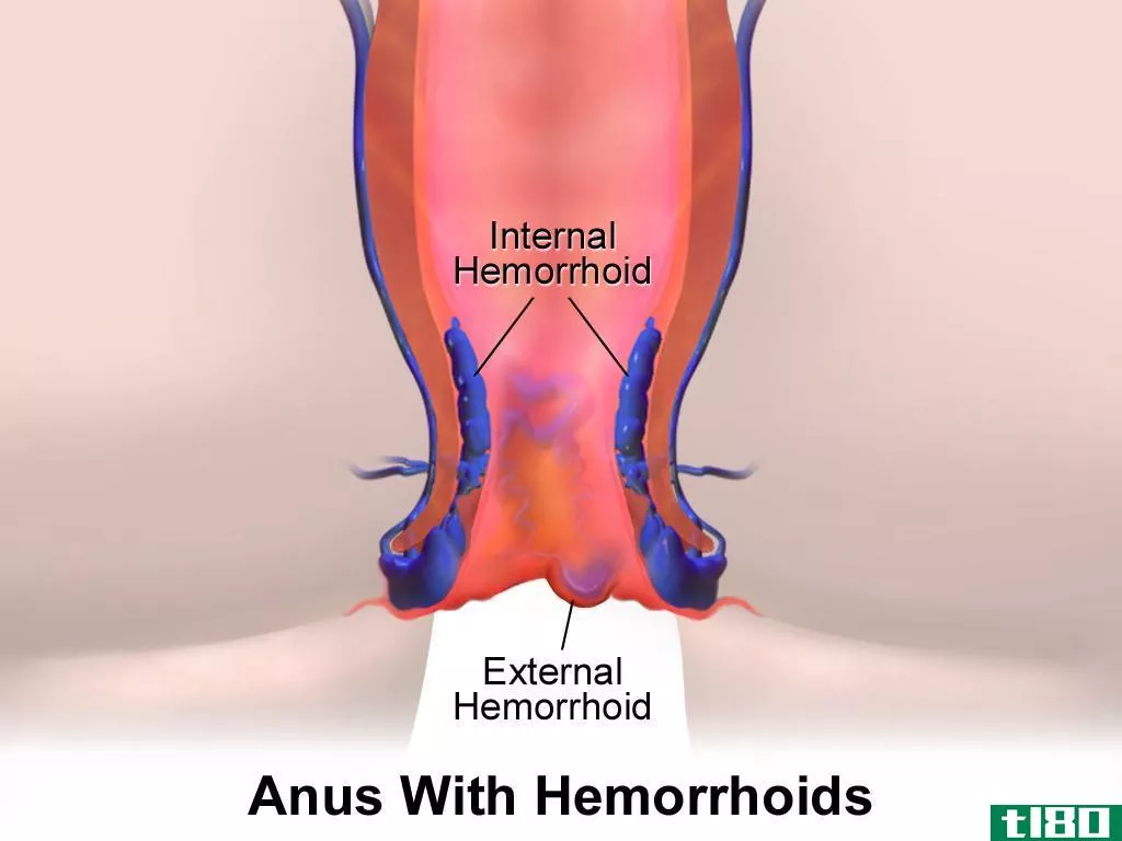 瘘管(fistula)和痔疮(hemorrhoids)的区别