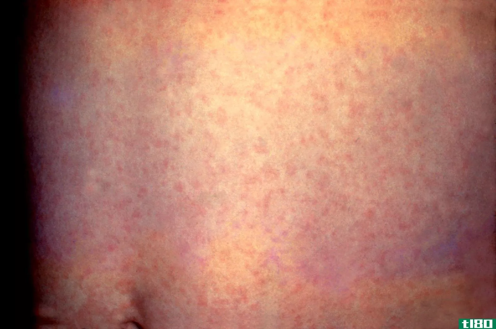 德国麻疹(german measles)和麻疹(measles)的区别