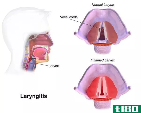 支气管炎(bronchitis)和喉炎(laryngitis)的区别