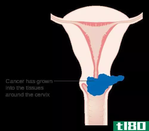 宫颈癌(cervical cancer)和人**瘤病毒(hpv)的区别
