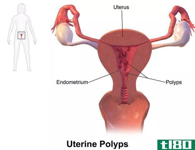 息肉(polyps)和纤维瘤(fibroids)的区别