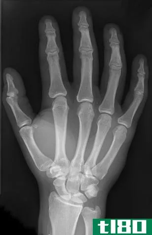 Difference Between X-Rays and Gamma Rays - Hand_X-Ray