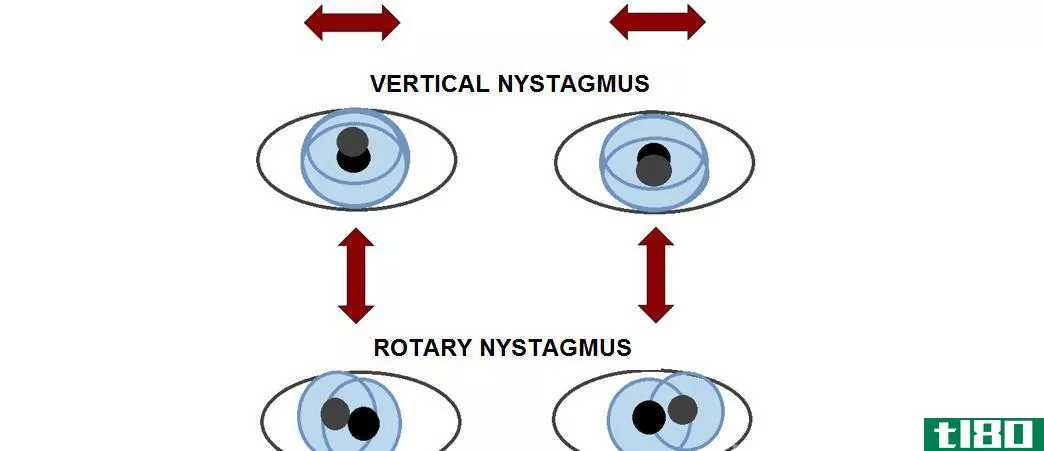 水平眼震(horizontal nystagmus)和垂直性眼球震颤(vertical nystagmus)的区别