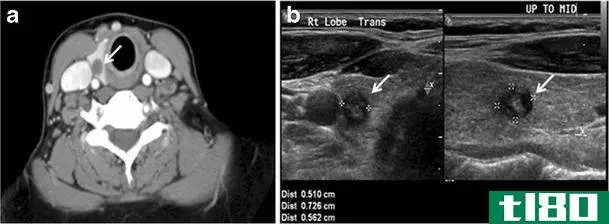 甲状腺结节(thyroid nodule)和囊肿(cyst)的区别