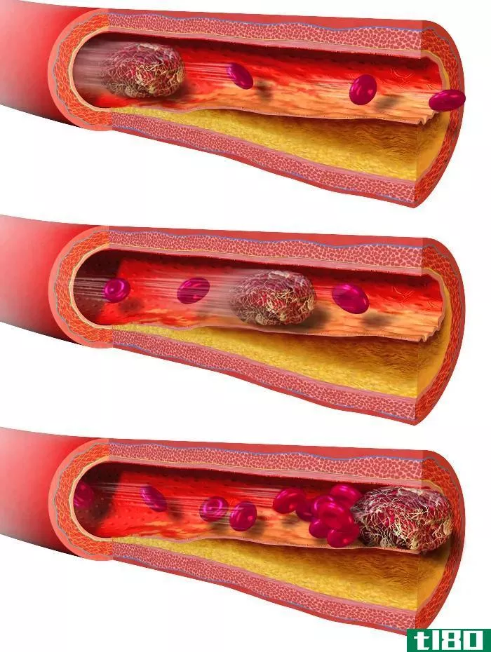 血块(blood clot)和流产(miscarriage)的区别