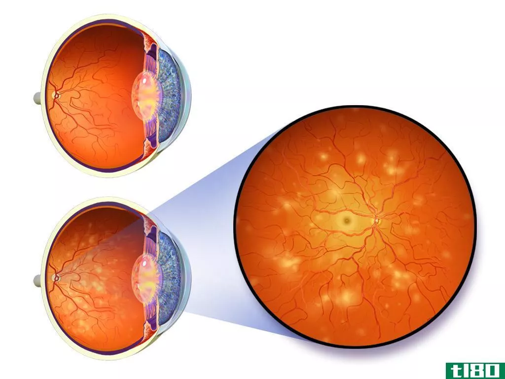 糖尿病性视网膜病变(diabetic retinopathy)和黄斑变性(macular degeneration)的区别