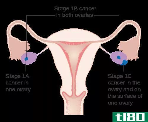 宫颈癌与卵巢癌