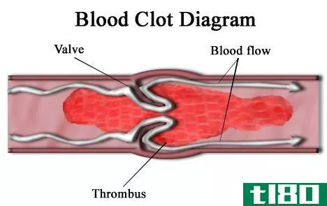 血块(blood clot)和动脉瘤(aneurysm)的区别
