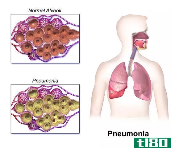 慢性阻塞性肺病(copd)和肺炎(pneumonia)的区别