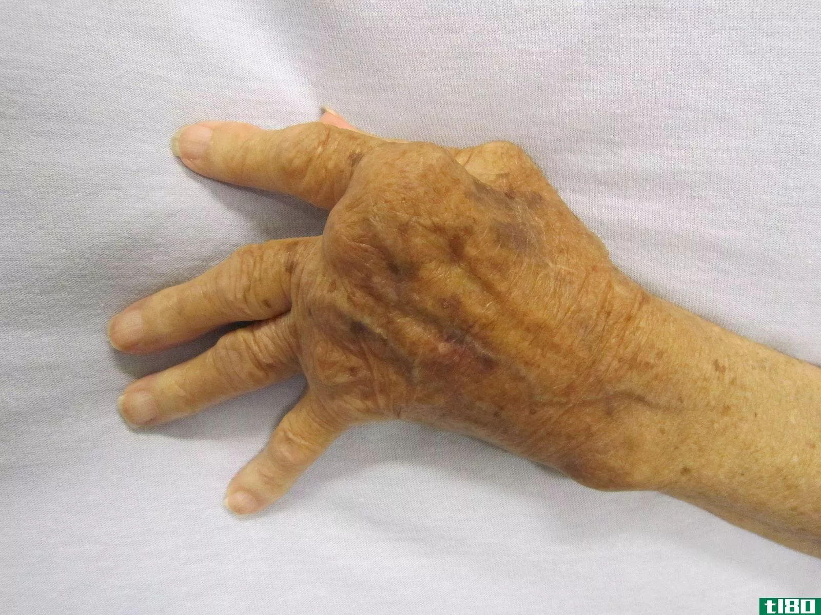痛风(gout)和类风湿性关节炎(rheumatoid arthritis)的区别