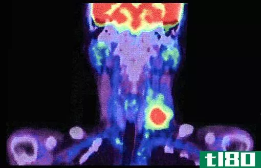 What Are Uses of Nuclear Radiation - A PET Scan