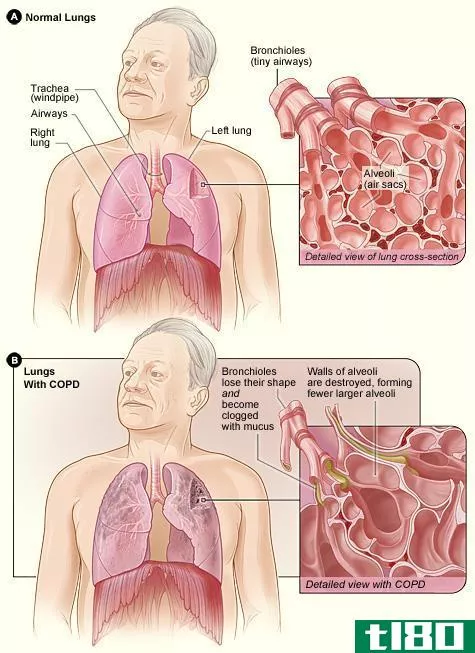 慢性阻塞性肺病(copd)和咳嗽(cough)的区别