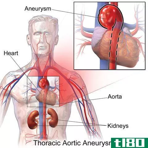 血块(blood clot)和动脉瘤(aneury**)的区别