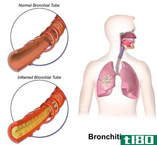 支气管炎(bronchitis)和毛细支气管炎(bronchiolitis)的区别