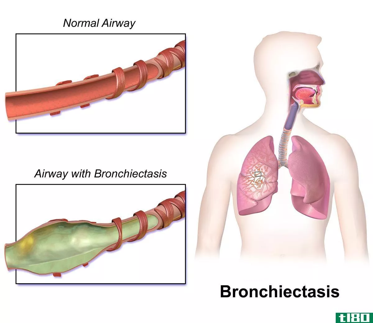 慢性阻塞性肺病(copd)和支气管扩张(bronchiectasis)的区别