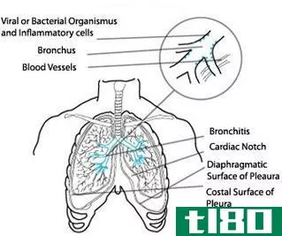 支气管炎(bronchitis)和急性支气管炎(acute bronchitis)的区别